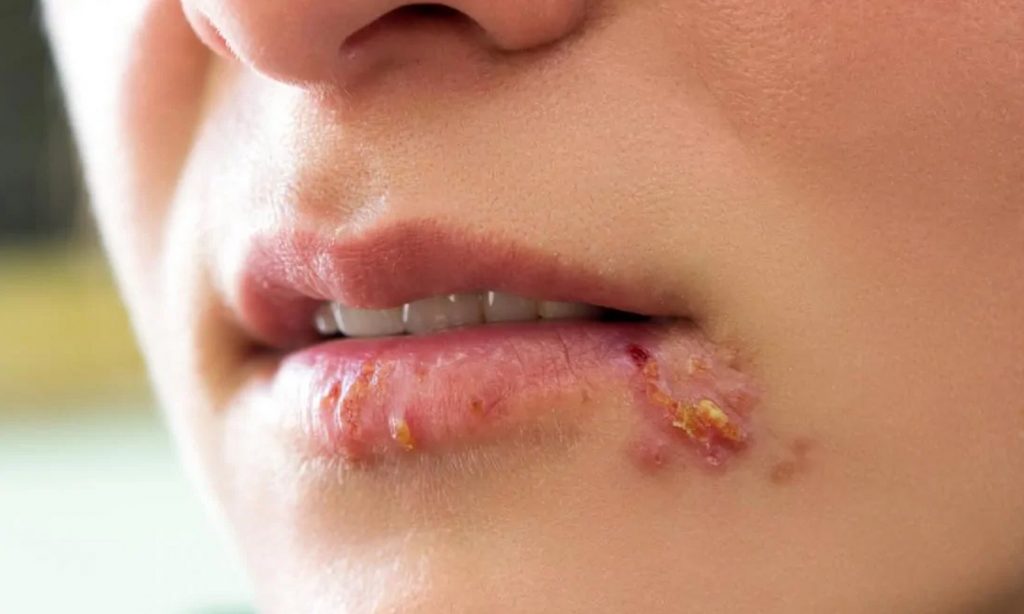 Këshilla e dermatologut se si të përshpejtoni shërimin e herpesit!